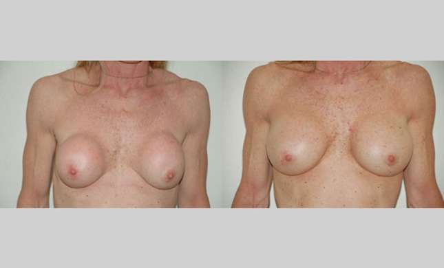 Breast Reconstruction: Image #319