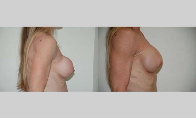 Breast Reconstruction: Image #320