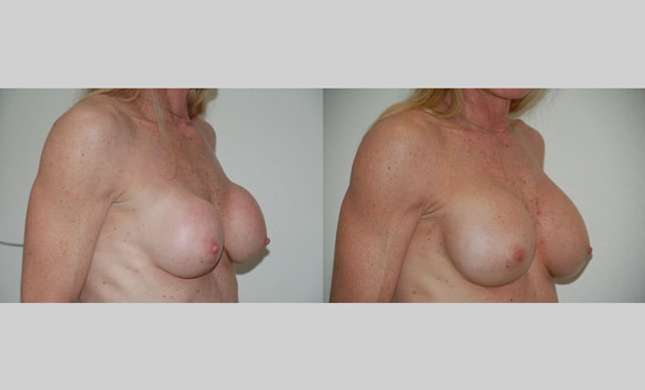 Breast Reconstruction: Image #321