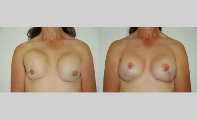 Breast Reconstruction: Image #322