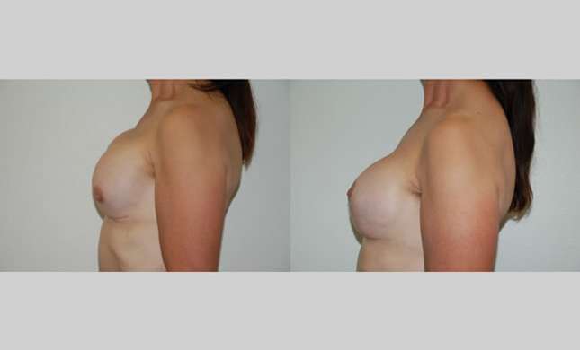 Breast Reconstruction: Image #323