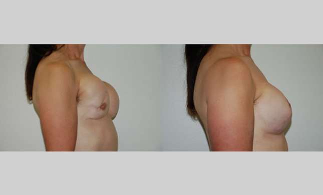 Breast Reconstruction: Image #324