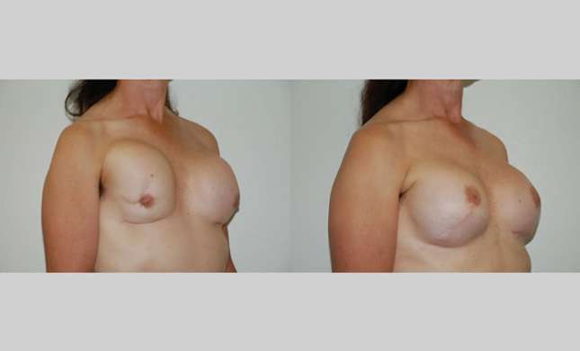 Breast Reconstruction: Image #325