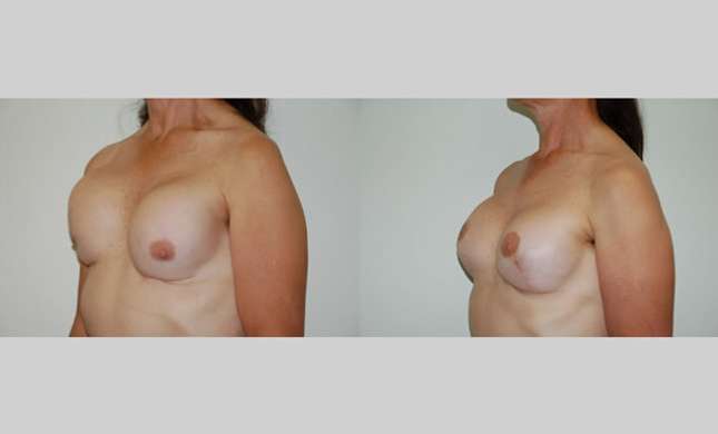 Breast Reconstruction: Image #326