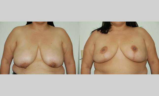 Breast Reduction: Image #331