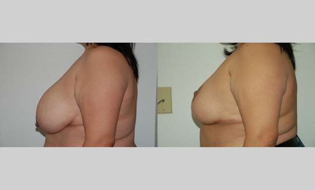 Breast Reduction: Image #332