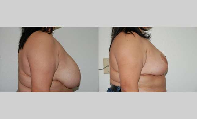 Breast Reduction: Image #333