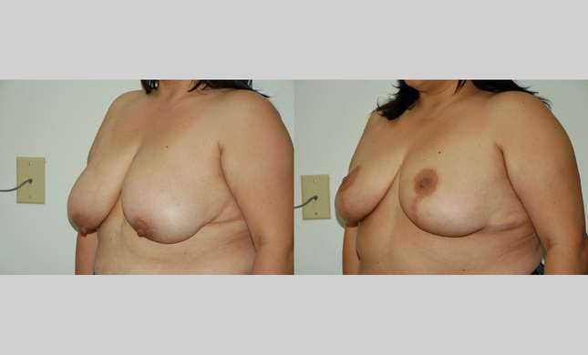 Breast Reduction: Image #334