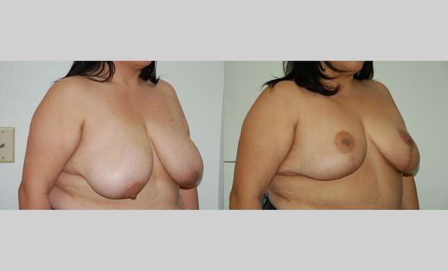 Breast Reduction: Image #335