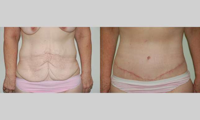 Body Lift: Image #336