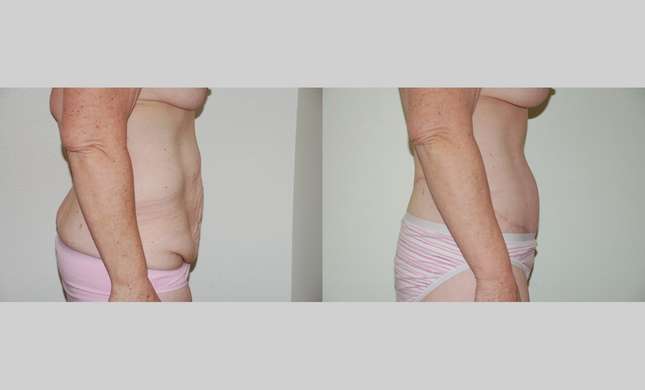Body Lift: Image #337