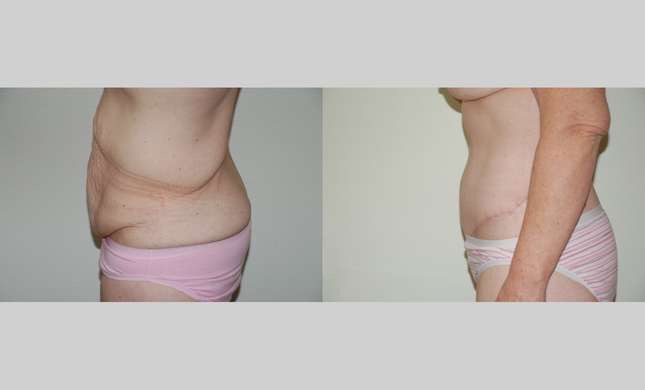 Body Lift: Image #338