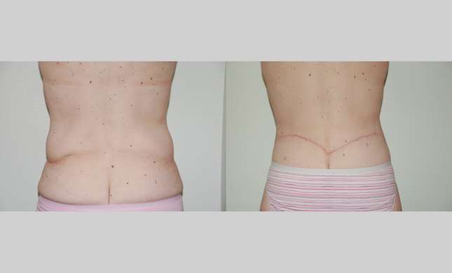 Body Lift: Image #339