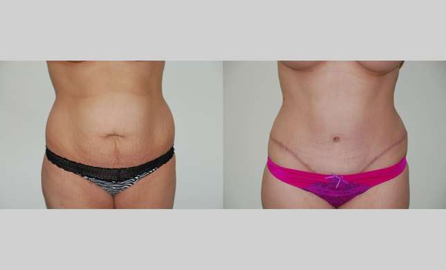 Tummy Tuck: Image #358