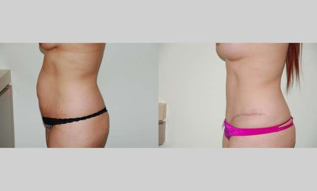 Tummy Tuck: Image #359