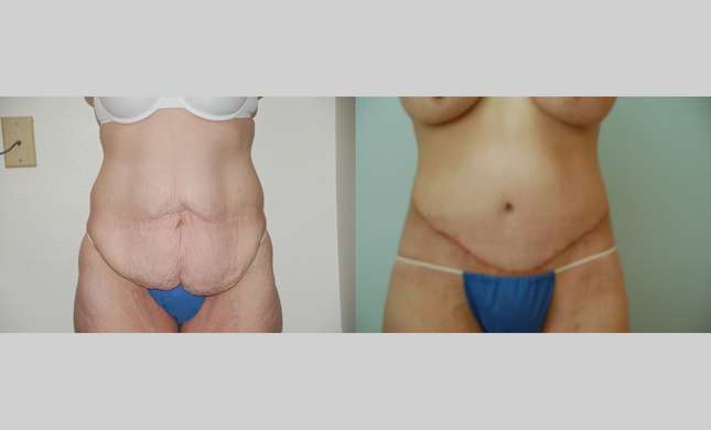 Body Lift: Image #383