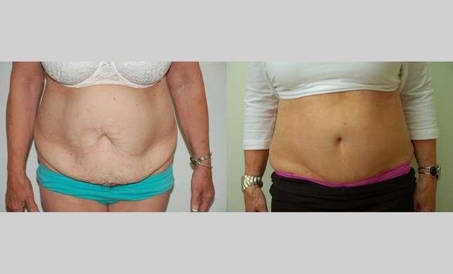 Tummy Tuck: Image #389