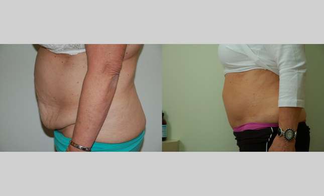 Tummy Tuck: Image #390