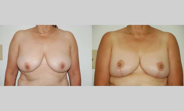 Breast Reduction: Image #391