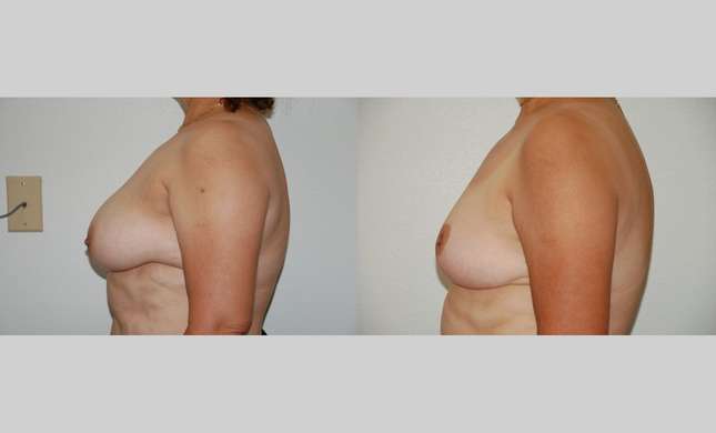 Breast Reduction: Image #392