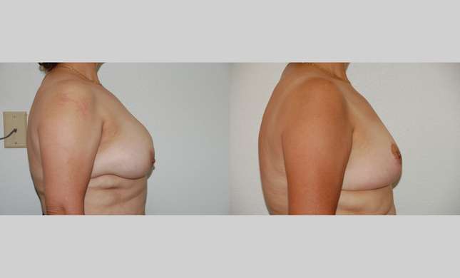 Breast Reduction: Image #393