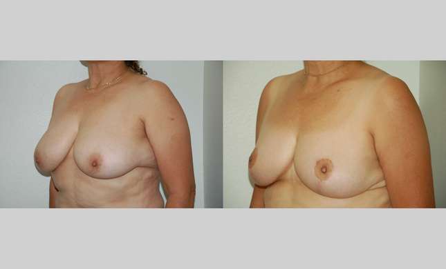 Breast Reduction: Image #394