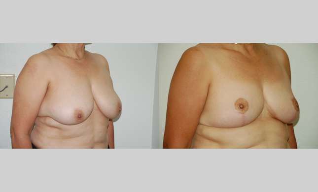 Breast Reduction: Image #395