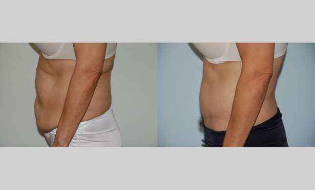 Body Lift: Image #397