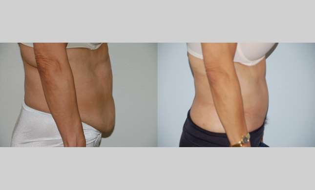 Body Lift: Image #398