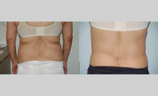 Body Lift: Image #399