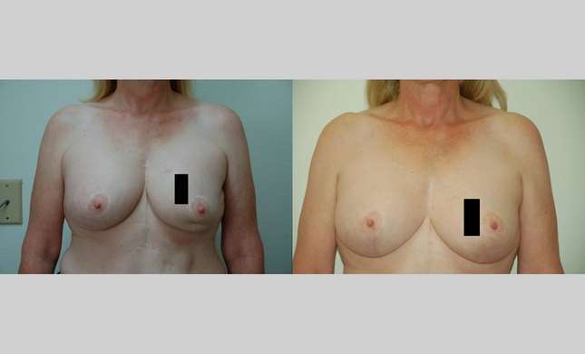 Breast Reconstruction: Image #418