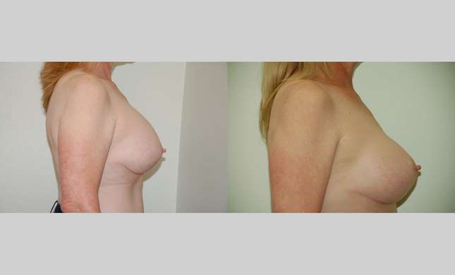 Breast Reconstruction: Image #419