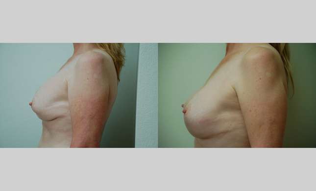 Breast Reconstruction: Image #420