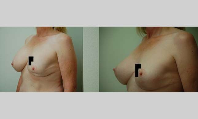 Breast Reconstruction: Image #421