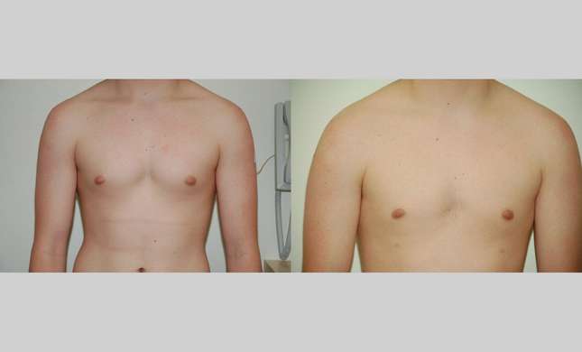 Male Breast Reduction: Image #427