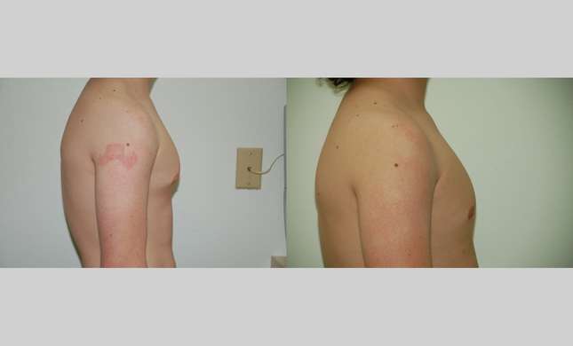 Male Breast Reduction: Image #428