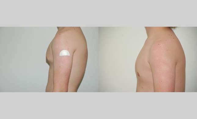 Male Breast Reduction: Image #429