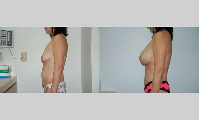Body Lift: Image #443
