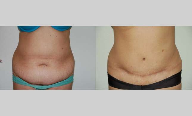 Tummy Tuck: Image #445