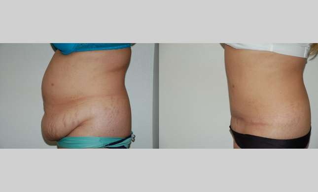 Tummy Tuck: Image #446