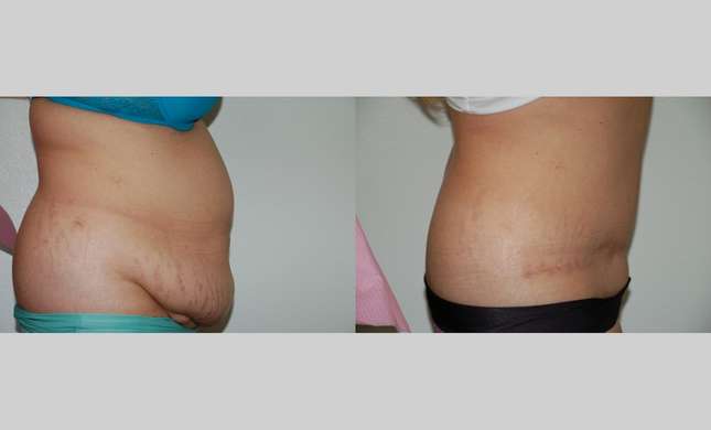 Tummy Tuck: Image #447