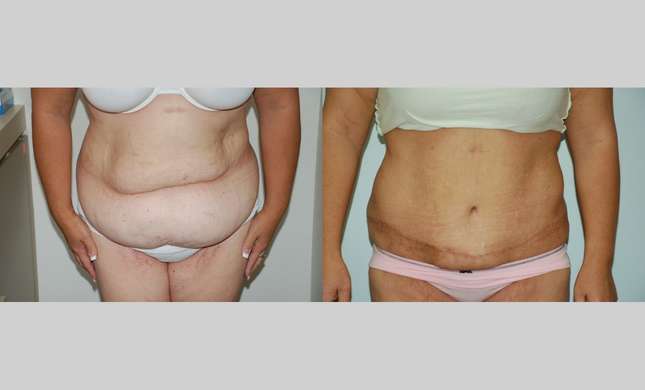 Tummy Tuck: Image #448