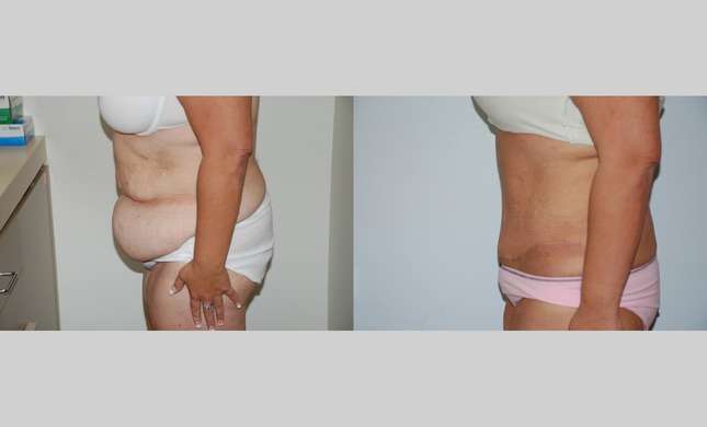 Tummy Tuck: Image #449