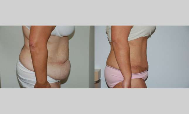 Tummy Tuck: Image #450