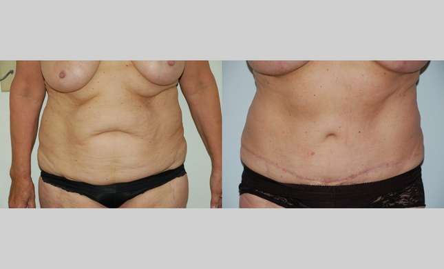 Tummy Tuck: Image #451
