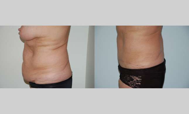 Tummy Tuck: Image #452