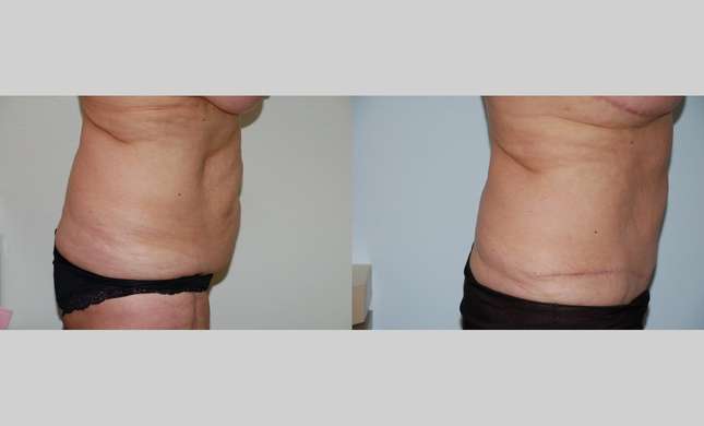 Tummy Tuck: Image #453