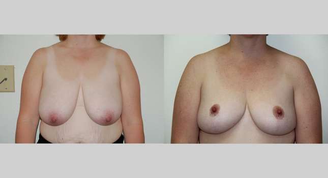Breast Reduction: Image #457