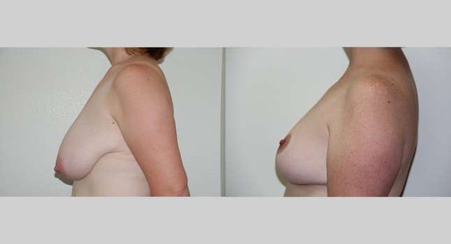 Breast Reduction: Image #458