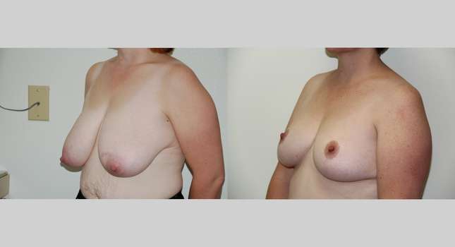 Breast Reduction: Image #459